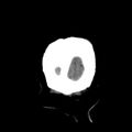 Cerebral hemorrhagic contusions (Radiopaedia 23145-23188 Coronal non-contrast 42).jpg