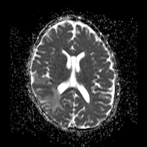 File:Cerebral tuberculoma (Radiopaedia 41152-43932 Axial ADC 13).jpg