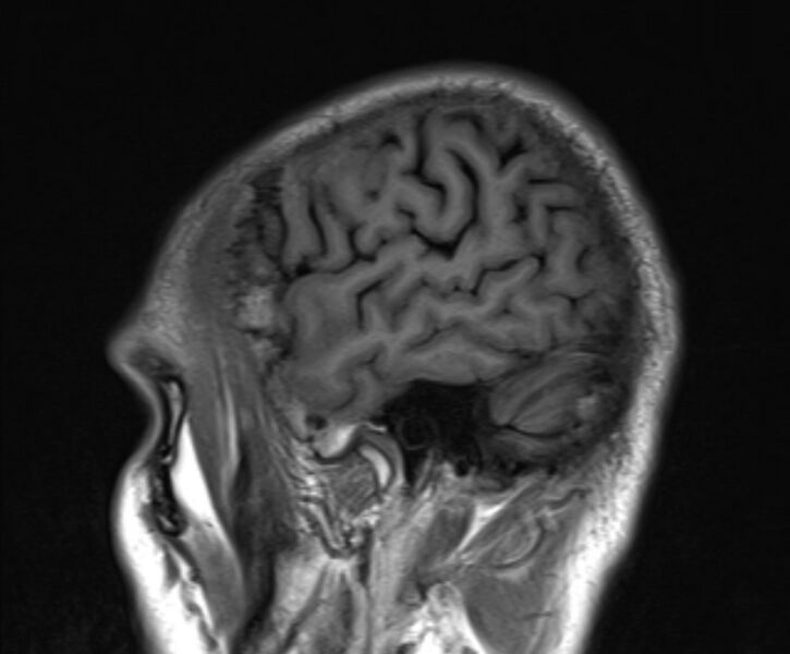File:Cerebral venous thrombosis (Radiopaedia 71207-81504 Sagittal T1 4).jpg