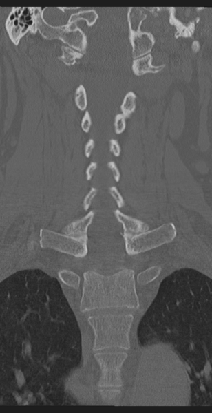 File:Cervical canal stenosis - OPLL and osteophytes (Radiopaedia 47329-51910 Coronal bone window 32).png