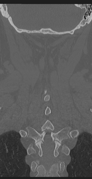 File:Cervical canal stenosis due to ossification of the posterior longitudinal ligament (Radiopaedia 47260-51823 Coronal bone window 50).png