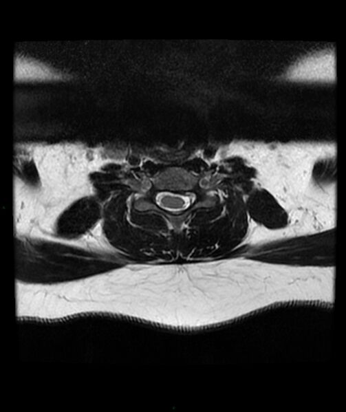 File:Cervical disc prolapse (Radiopaedia 80258-93598 Axial T2 47).jpg