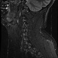 Cervical flexion teardrop fracture with cord hemorrhage (Radiopaedia 32497-33455 Sagittal STIR 1).jpg