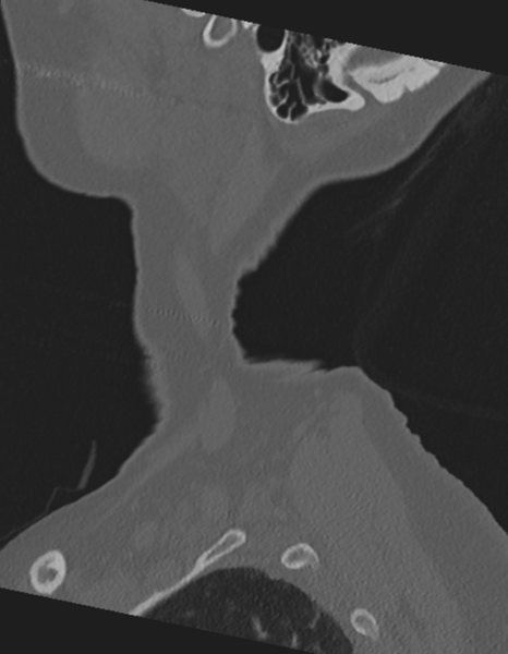 File:Cervical spine ACDF loosening (Radiopaedia 48998-54071 Sagittal bone window 8).png
