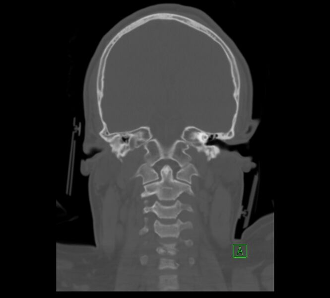 File:Cervical spine fracture - hyperflexion injury (Radiopaedia 66184-75364 Coronal bone window 4).jpg