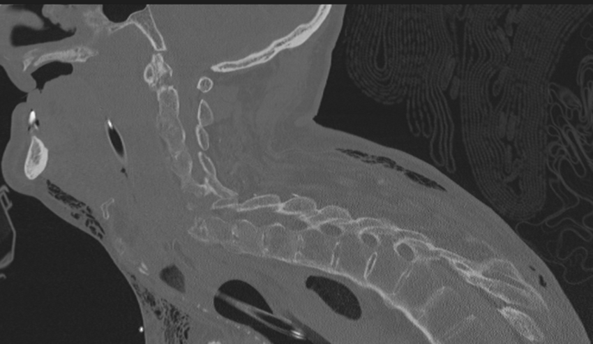Chalk stick fracture (Radiopaedia 57948-64928 Sagittal bone window 37).png