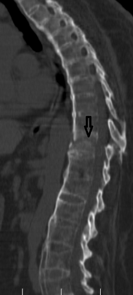 File:Chalk stick fracture - ankylosing spondylitis (Radiopaedia 52572-58513 Sagittal bone window 1).png