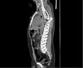 Chance fracture (Radiopaedia 38398-40475 Sagittal bone window 1).jpeg