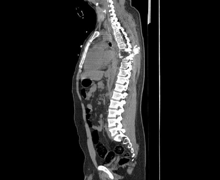 File:Chance fracture (Radiopaedia 38398-40475 Sagittal bone window 1).jpeg