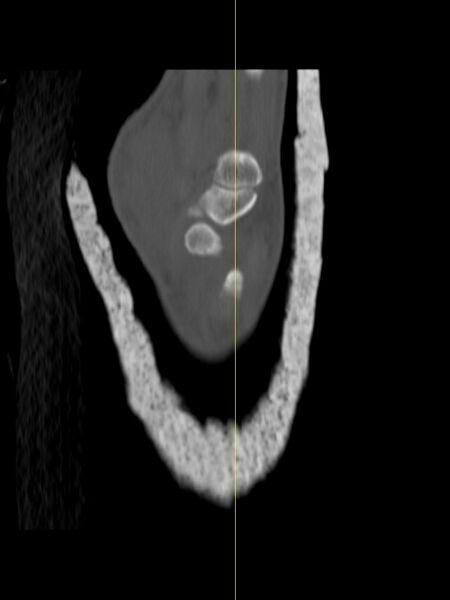 File:Chauffeur's (Hutchinson) fracture (Radiopaedia 58043-65079 Sagittal bone window 18).jpg