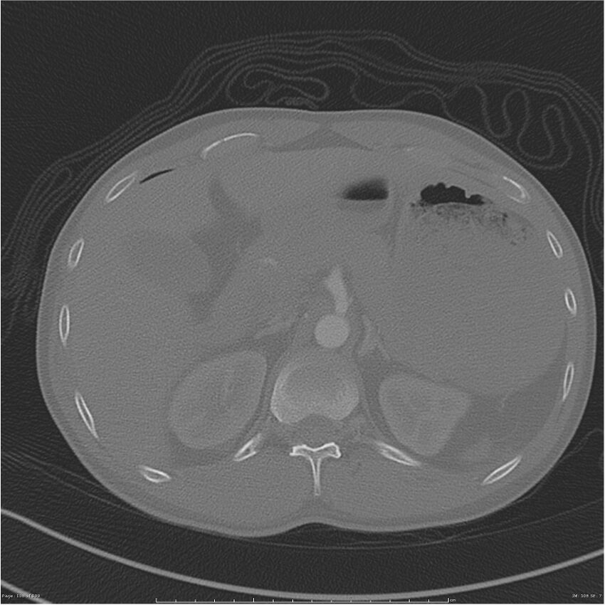 Chest and abdomen multi-trauma (Radiopaedia 26294-26425 bone window 108).jpg