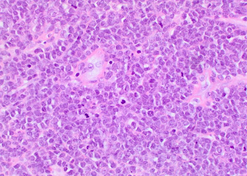 File:Chloroma - acute myeloid leukemia (Radiopaedia 66668-75975 B 1).jpg