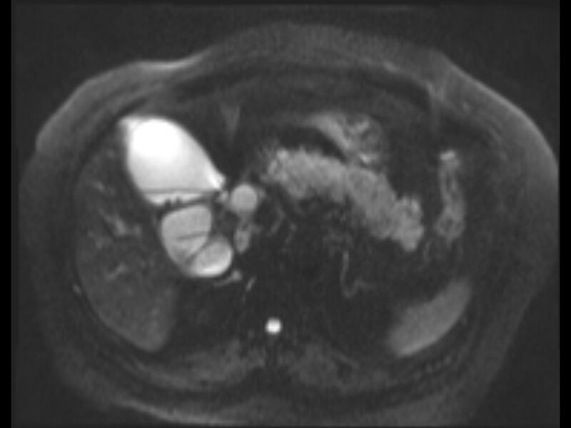 File:Choledocholithiasis causing intrahepatic biliary duct dilation (Radiopaedia 39908-42369 Axial T2 SPAIR 41).jpg