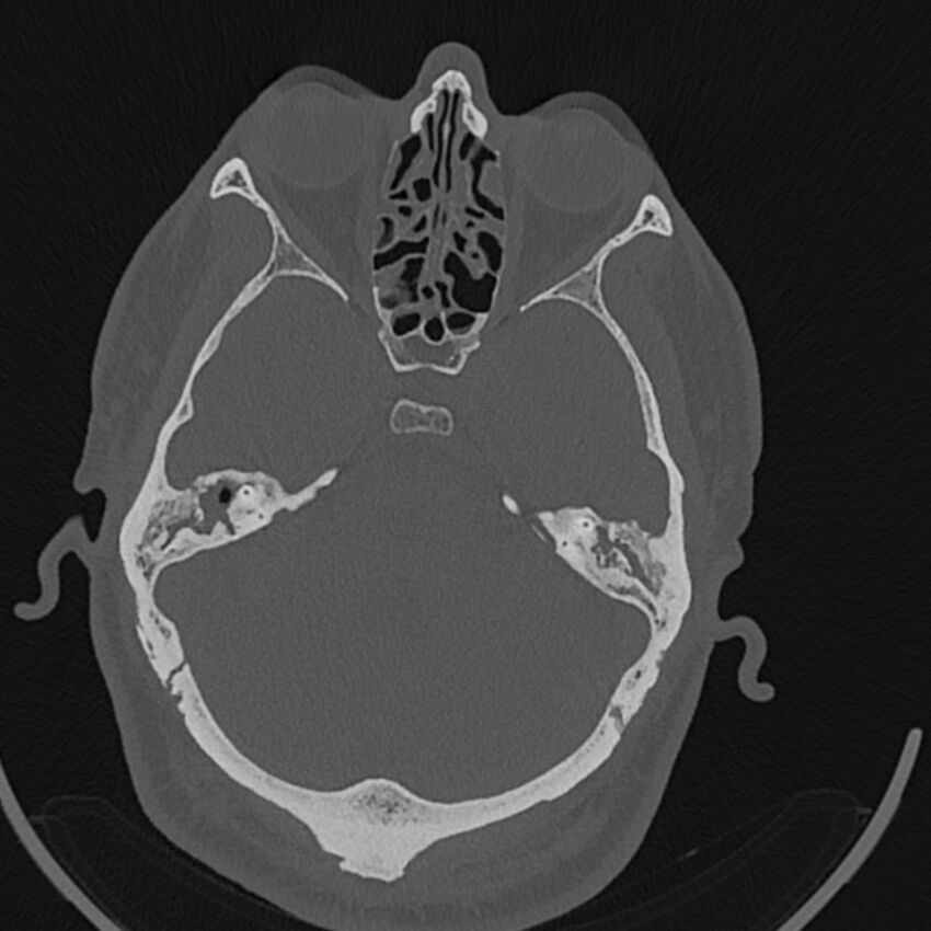 Cholesteatoma (Radiopaedia 68176-77673 Axial bone window 62).jpg