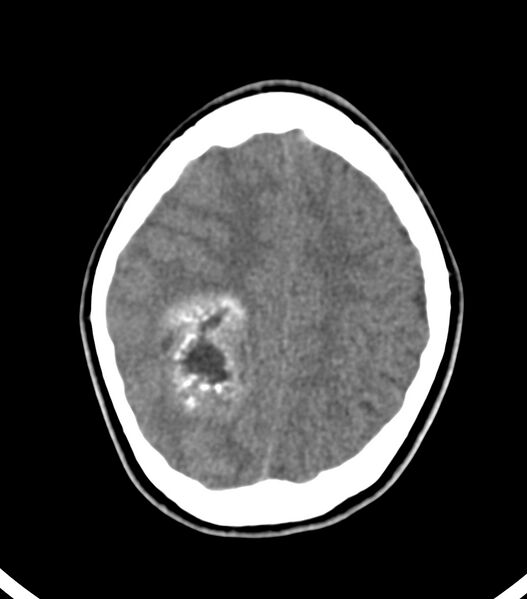 File:Choroid plexus carcinoma (Radiopaedia 91013-108552 Axial non-contrast 47).jpg