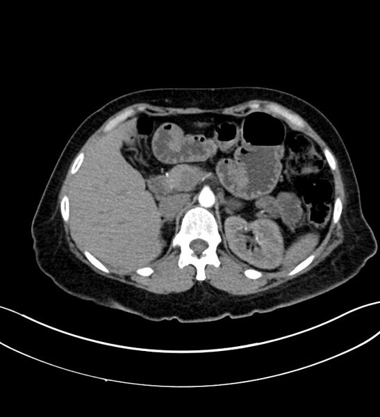File:Chromophobe renal cell carcinoma (Radiopaedia 84290-99582 B 10).jpg
