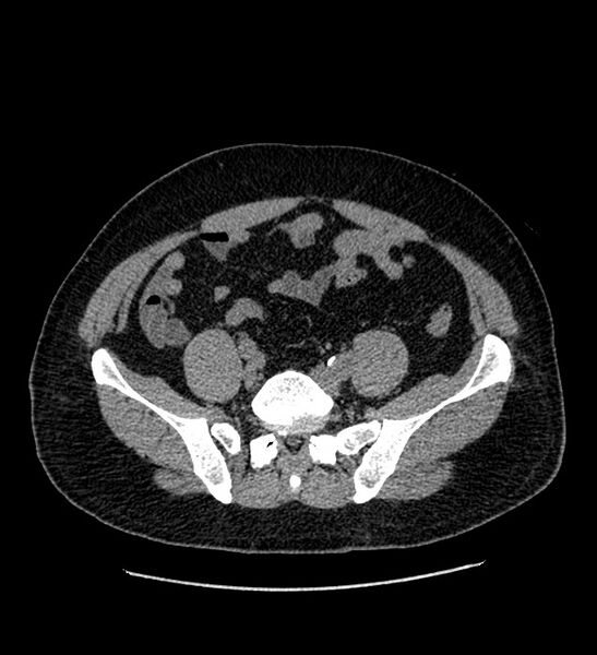 File:Chromophobe renal cell carcinoma (Radiopaedia 84337-99693 Axial non-contrast 113).jpg