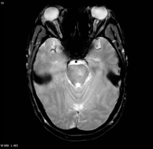 File:Chronic hypertensive encephalopathy (Radiopaedia 4564-6686 Axial Gradient Echo 5).jpg