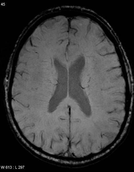 File:Chronic lymphocytic inflammation with pontine perivascular enhancement responsive to steroids (CLIPPERS) (Radiopaedia 37520-39374 Axial SWI 44).jpg