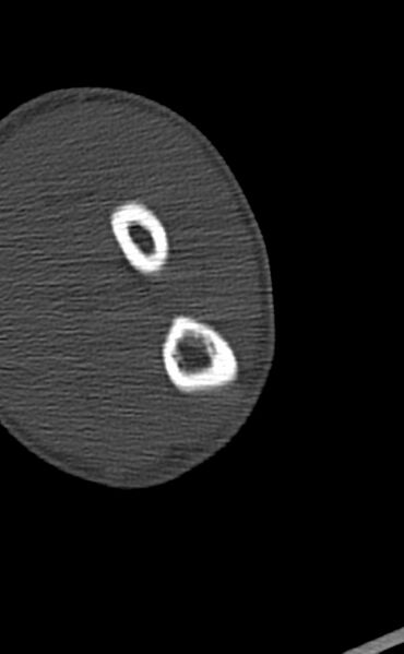 File:Chronic osteomyelitis of the distal humerus (Radiopaedia 78351-90971 Axial bone window 115).jpg