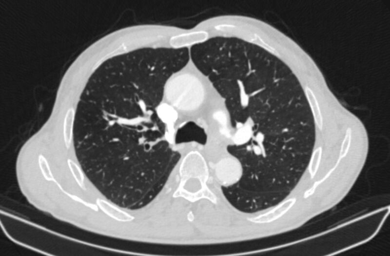File:Chronic pulmonary embolism (Radiopaedia 91241-108843 Axial lung window 33).jpg