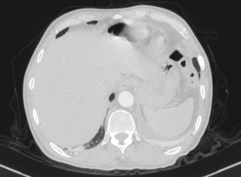 File:Chronic pulmonary embolism with bubbly consolidation (Radiopaedia 91248-108850 Axial lung window 136).jpg