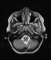 Chronic reactive multifocal osteomyelitis (CRMO) - mandible (Radiopaedia 56405-63069 Axial T2 20).jpg