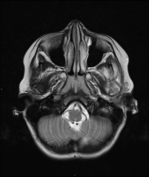 File:Chronic reactive multifocal osteomyelitis (CRMO) - mandible (Radiopaedia 56405-63069 Axial T2 20).jpg