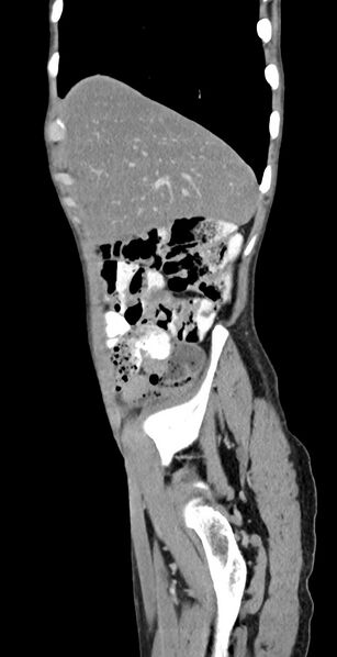 File:Chronic small bowel volvulus (Radiopaedia 75224-86322 C 121).jpg