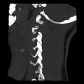 Clay-shoveler fracture (Radiopaedia 22568-22590 Sagittal MIP 1).jpg