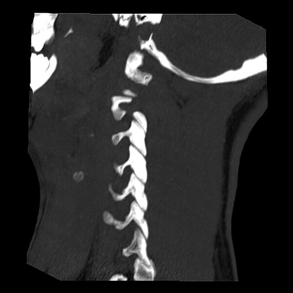 File:Clay-shoveler fracture (Radiopaedia 22568-22590 Sagittal MIP 1).jpg