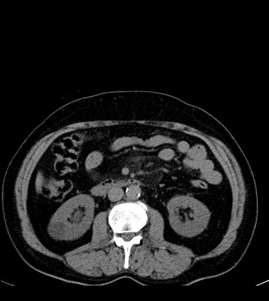 File:Clear cell renal cell carcinoma (Radiopaedia 85006-100539 Axial non-contrast 42).jpg