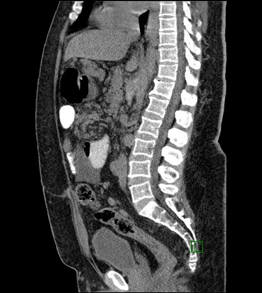 File:Closed-loop small bowel obstruction-internal hernia (Radiopaedia 78439-91096 C 77).jpg