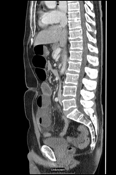 File:Closed loop bowel obstruction and ischemia (Radiopaedia 86959-103180 C 33).jpg