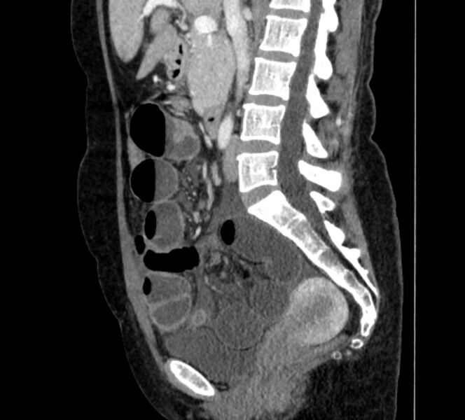 File:Closed loop small bowel obstruction (Radiopaedia 71211-81508 C 69).jpg