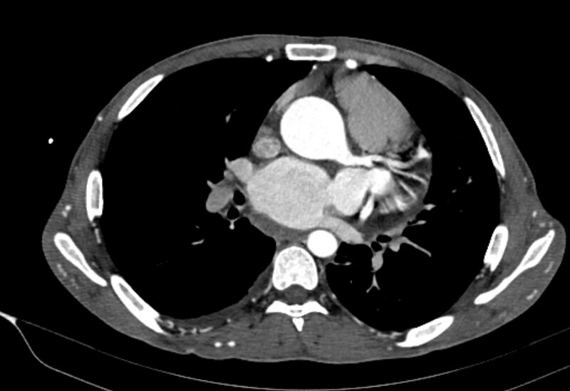 File:Coarctation of aorta with aortic valve stenosis (Radiopaedia 70463-80574 A 102).jpg