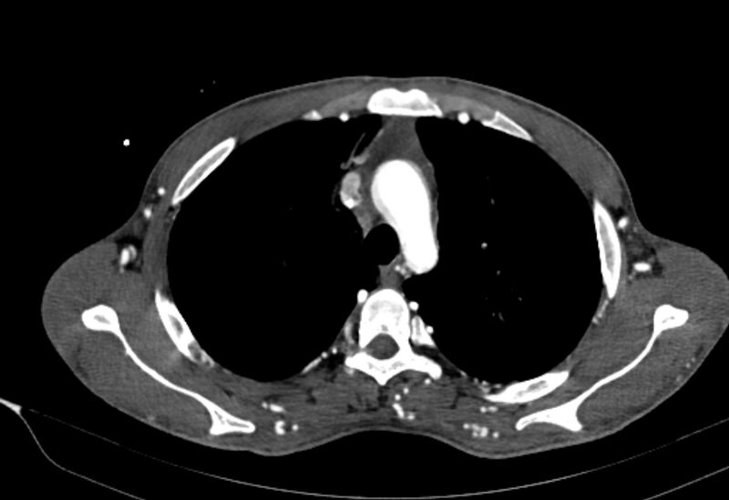 File:Coarctation of aorta with aortic valve stenosis (Radiopaedia 70463-80574 A 33).jpg