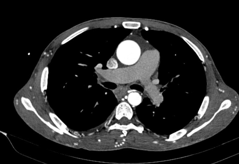 File:Coarctation of aorta with aortic valve stenosis (Radiopaedia 70463-80574 A 76).jpg