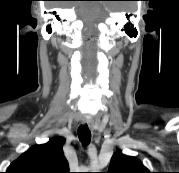 File:Colloid cyst of thyroid (Radiopaedia 22897-22923 Coronal C+ delayed 36).jpg