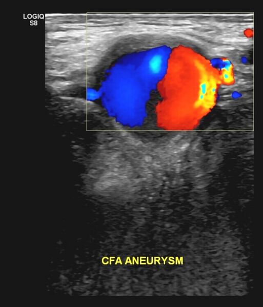 File:Common femoral artery aneurysm (Radiopaedia 60903).jpg