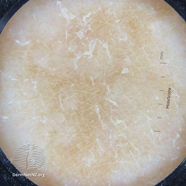 File:Dermoscopy of pityriasis versicolor (DermNet NZ dermoscopy-pityriasis-versicolor).jpg