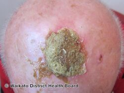 Erosive pustular dermatitis of the scalp
