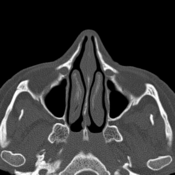 File:Nasolabial cyst (Radiopaedia 33987-35205 Axial bone window 21).jpg