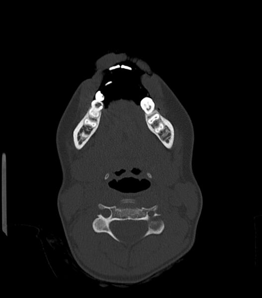 File:Nasoorbitoethmoid fracture (Radiopaedia 90044-107205 Axial bone window 30).jpg