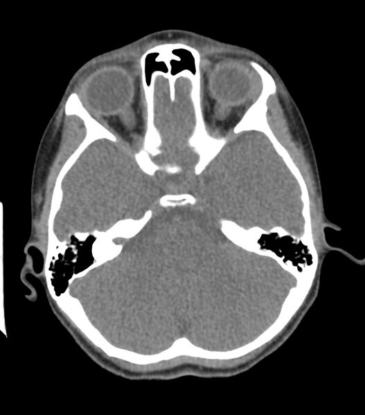 File:Nasoorbitoethmoid fracture (Radiopaedia 90044-107205 Axial non-contrast 169).jpg