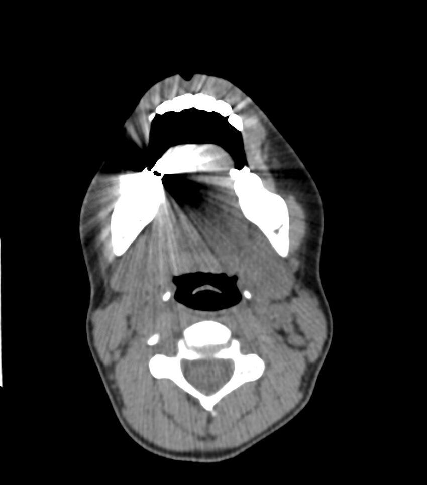 Nasoorbitoethmoid fracture (Radiopaedia 90044-107205 Axial non-contrast 65).jpg