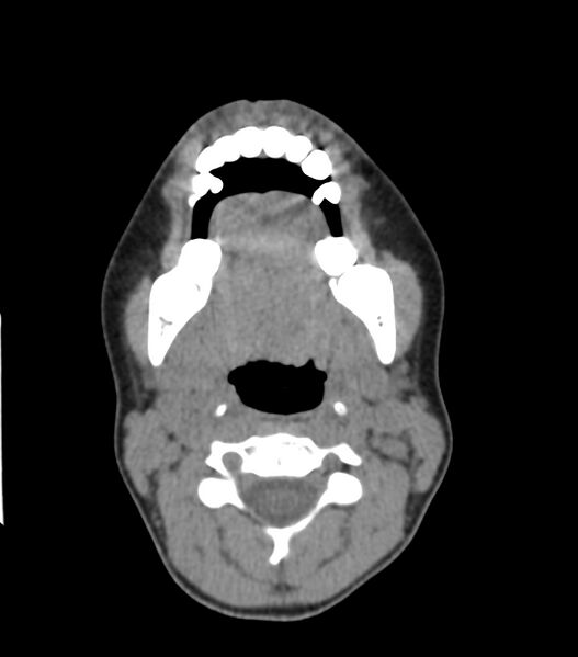 File:Nasoorbitoethmoid fracture (Radiopaedia 90044-107205 Axial non-contrast 71).jpg