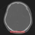 Nasopharyngeal carcinoma recurrence - skull base destruction (Radiopaedia 29107-29490 Axial bone window 54).jpg