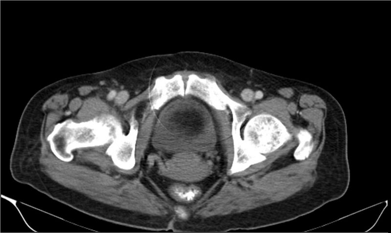 File:Necrotizing pancreatitis (Radiopaedia 20595-20495 A 45).jpg