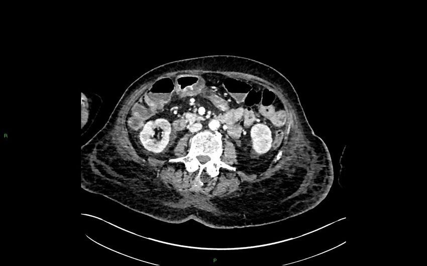 Neo-terminal ileal stricture (Crohn disease) (Radiopaedia 33790-34948 A 204).jpg